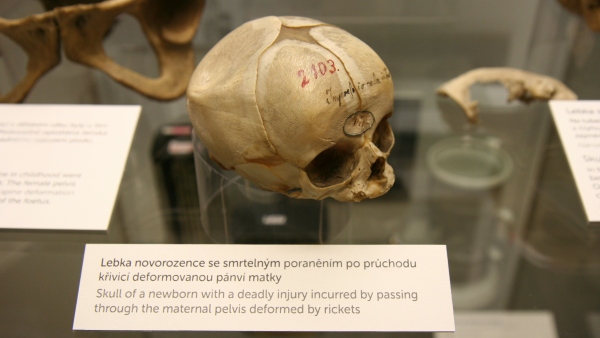 foto: lebka novorozence se smrtelným poraněním po průchodu křivicí deformovanou pánví matky